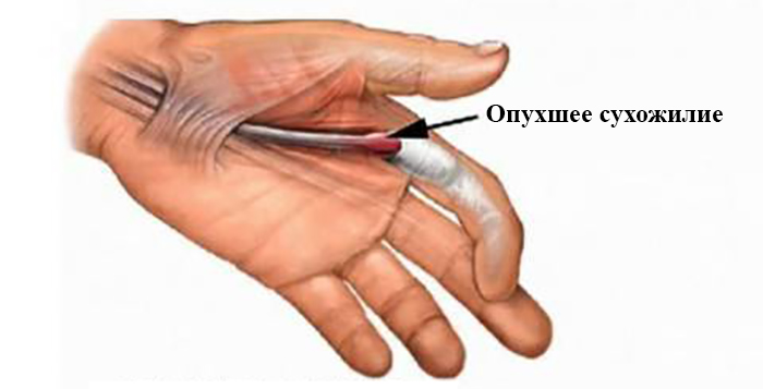 Синдром щелкающего пальца