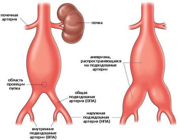 Аневризма в артерии