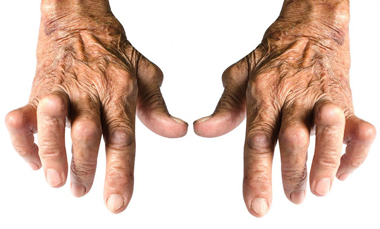 Пальцы при артрите
