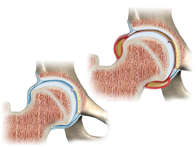 Транзиторный синовит тазобедренного сустава