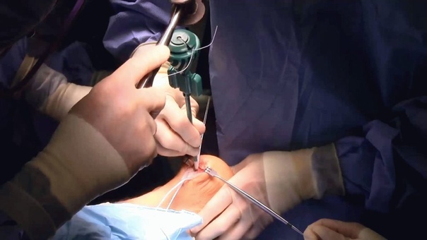 Удаление пяточной шпоры хирургическим путем. Виды операций, их преимущества и недостатки