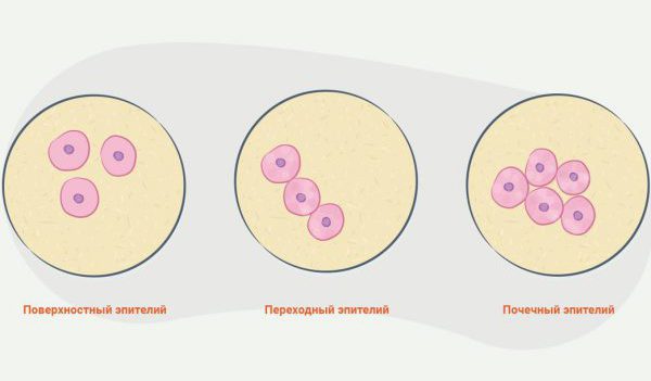 Почему появляются клетки плоского эпителия в моче