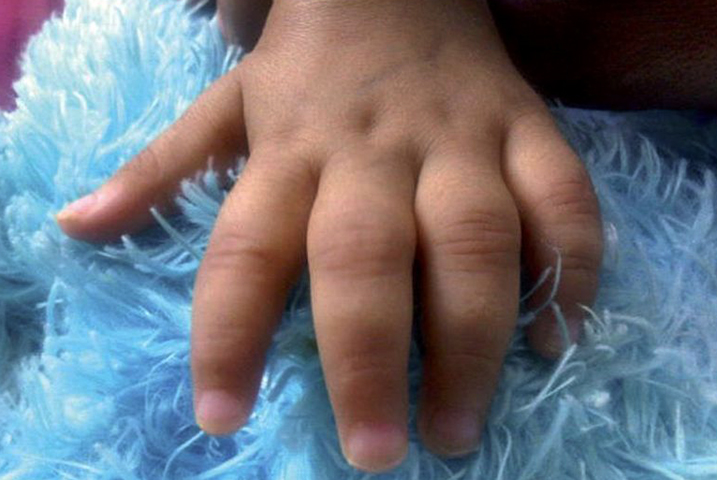 Артрит на руке у ребенка