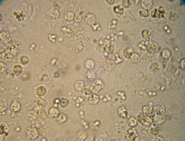 В каких случаях в моче у ребенка появляются лейкоциты