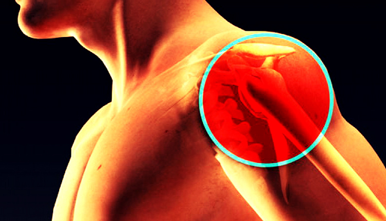 Как выглядит плечевой остеохондроз