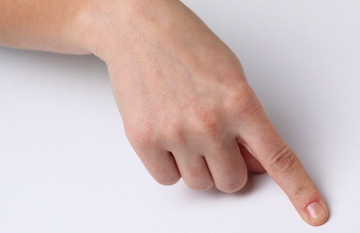 Выбитый указательный палец