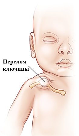 Как выглядит перелом ключицы у малыша