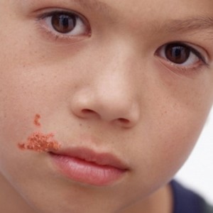 Причины и лечение герпеса на лице у ребенка