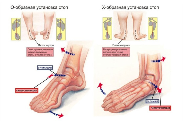 Вальгусная (варусная) деформация ступней и пяток. Причины развития, методы лечения у детей и взрослых