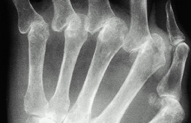 Артрит на рентгене