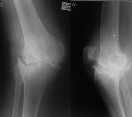 Ревматоидный артрит коленного сустава на снимке