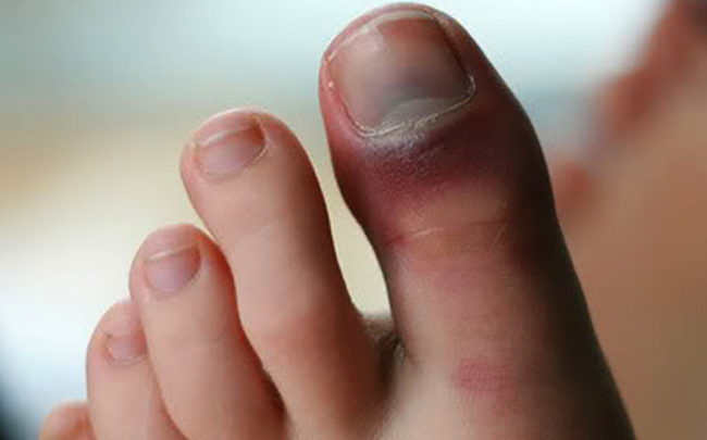 Ушиб пальца на ноге