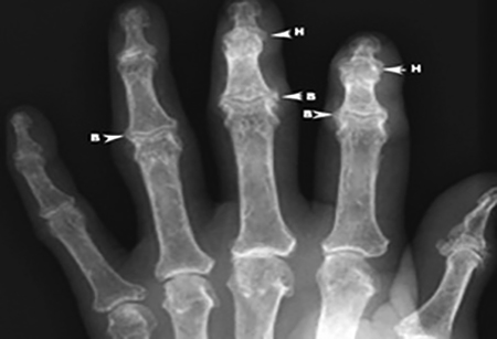 Артроз на рентгеновском снимке