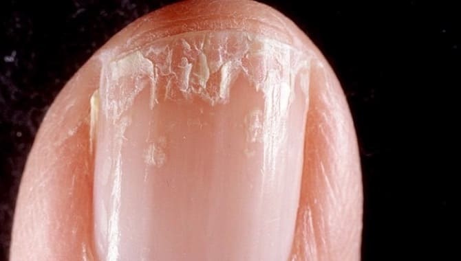 Расслоение ногтя