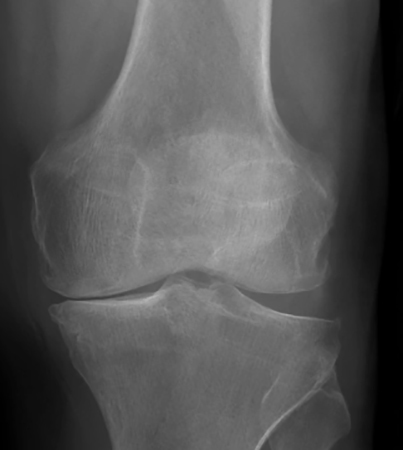 Снимок артрита колена