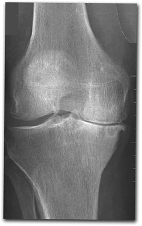 Снимок остеоартроза коленного сустава