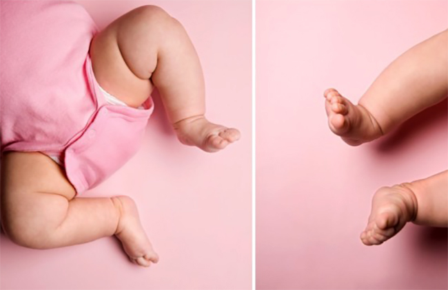 Незрелость тазобедренных суставов у малыша
