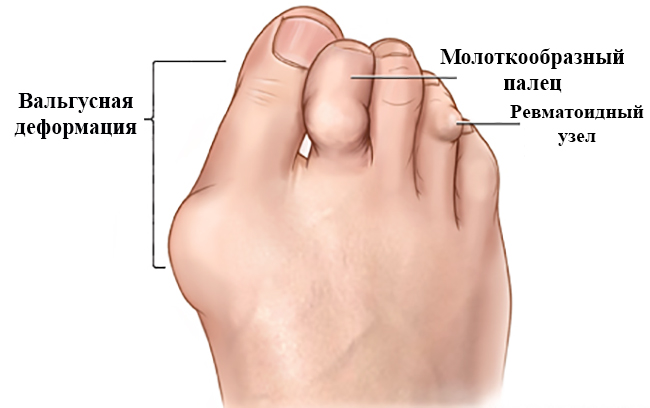 Артрит пальцев ноги