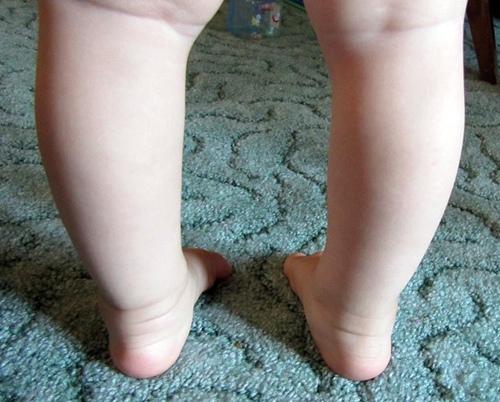Вальгусная (варусная) деформация ступней и пяток. Причины развития, методы лечения у детей и взрослых