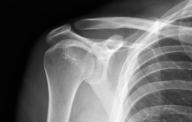 Остеопороз плечевого сустава на снимке