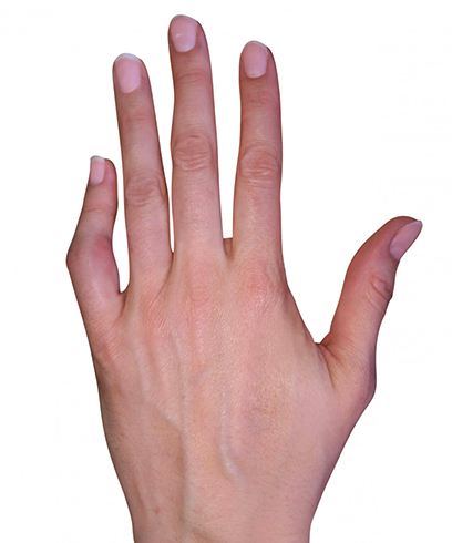 Как выглядит вывих пальца