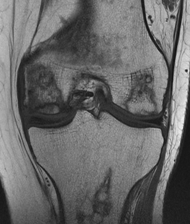 Асептический некроз коленного сустава на снимке