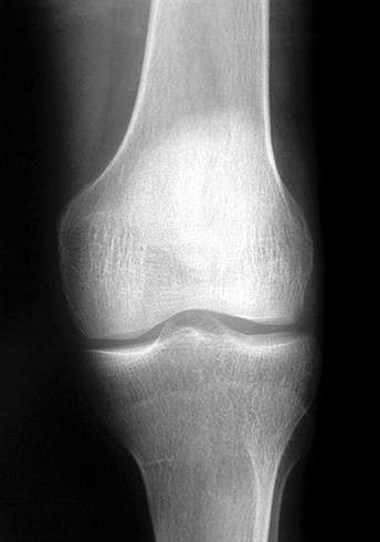 Снимок коленного сустава