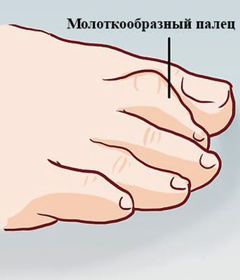 Молоткообразный палец