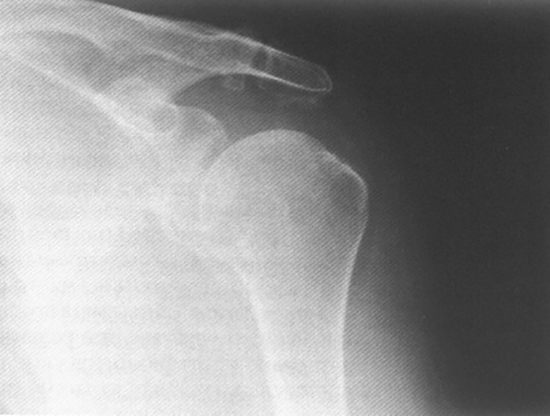 Рентген при плечелопаточном периартрите