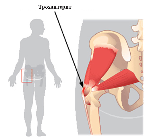Трохантерит схема лечения