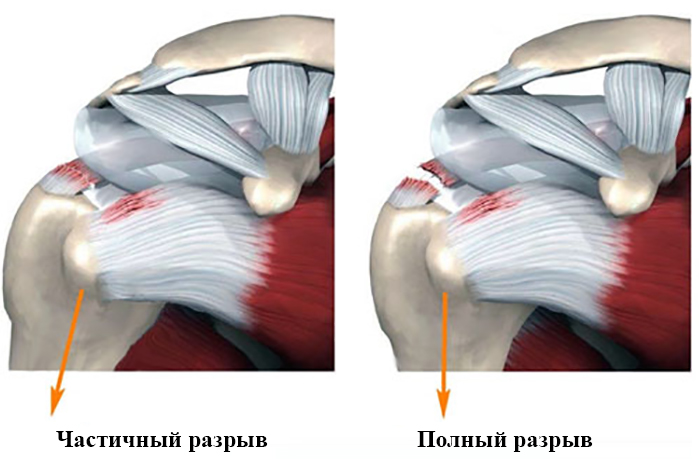 Надостная мышца 2gym