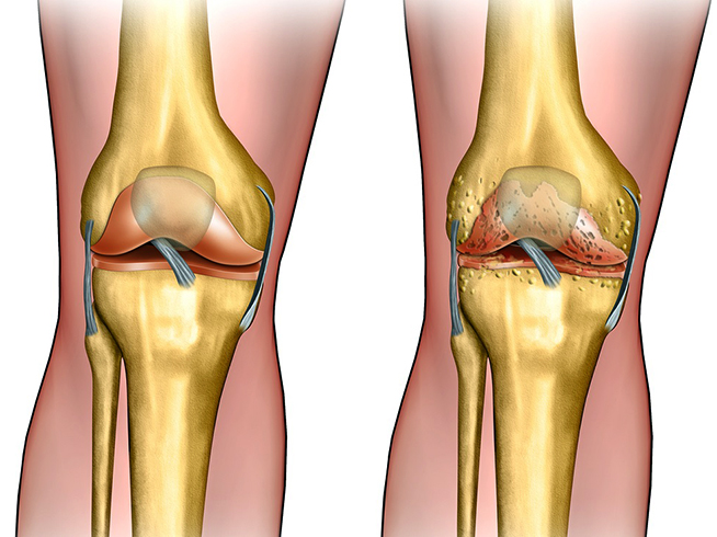 Как выглядит артроз коленного сустава фото