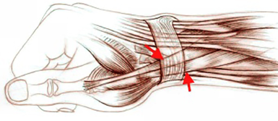 Синдром де кервена лечение. Тендовагинит де Кервена кисти. Теносиновит де Кервена. Теносиновит сухожилия кисти. Тендовагинит де Кервена операция.