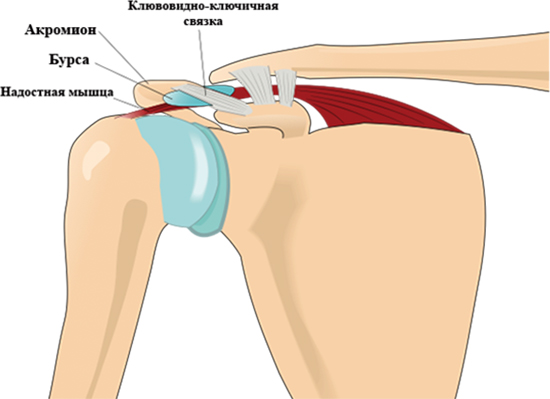 Импичмент плечевого сустава. Импинджмент плечевого сустава. Артроз плечевого сустава импинджмент синдром. Клювовидно акромиальная связка. Импичмент синдром плечевого сустава это.